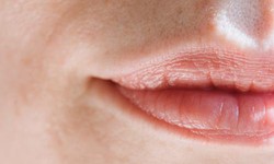 Perfecting Your Pout: Lip Filler Correction Explained