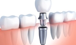 How Does Age Affect the Success of All-on-4 Dental Implants?