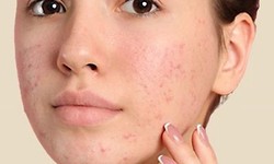 Miracle on Your Skin: Dubai's Acne Marvels