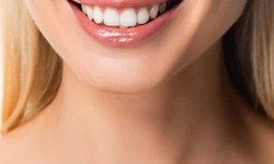Get Ready to Shine: Teeth Whitening Solutions in Islamabad