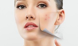 Radiant Skies: Acne Solutions in the City of Gold