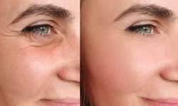 Unveiling Youthful Radiance: Eye Bag Removal in Islamabad