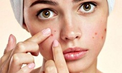 Why All the Fuss About Acne Treatment in Dubai?