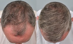 Hair Transplant at the Age of 40