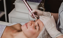 How Much Does RF Microneedling REALLY Cost in Singapore? (Price Breakdown!)