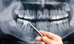 A Comprehension to Dental X-Rays Services: A Pathway to Better Oral Health