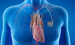 Can Having a Pacemaker Qualify for Social Security Disability and SSI?