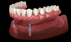Dubai's Finest Dental Implant Solutions Unveiled