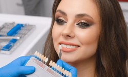 Revitalize Your Smile: The Ultimate Guide to Dental Veneers