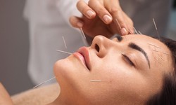 How Does Acupuncture Offer Relief from Anxiety?