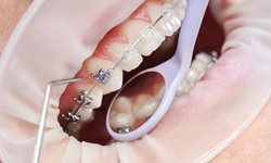 Recognizing the Elements That Impact the Cost of Dental Braces