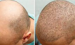 "Mane Makeover: Transforming Lives at the Best Hair Transplant Clinic in India"