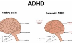 Handling Impulsivity and Hyperactivity in the Treatment of ADHD