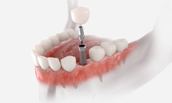 What Is The Best Type Of Dental Implant To Get?