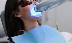 Illuminating Smiles: Laser Teeth Whitening in Islamabad