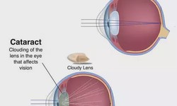 What is Cataract Surgery: Risks, Recovery, Costs