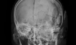 Brain Hemorrhage Symptoms Demystified: What to Watch For