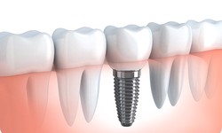 The Ultimate Guide to Dental Implants: What You Need to Know