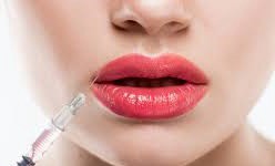The Art and Science behind Cosmetic Lip Fillers
