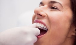 The Royal Treatment: Dental Crowns in Ventura Unveiled