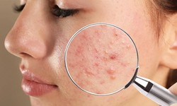 Dubai's Skincare Revolution: Unveiling the Best Acne Treatment Yet!