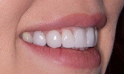 Why Dental Veneers Are the Best Solution for Crooked Teeth