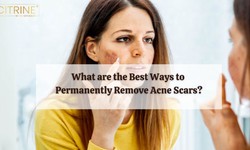 What are the Best Ways to Permanently Remove Acne Scars?