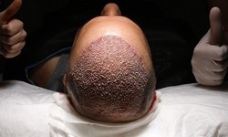 The Ultimate Guide to Hair Transplant in Islamabad