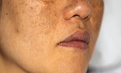 How to Maximize the Benefits of Pigmentation Treatment