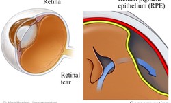A Clear Vision: Retina Detachment Surgery in India