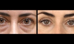 Innovations in Bulging Eyes Surgery: Advances and Future Prospects