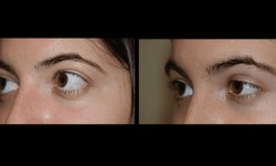 The Evolution of Techniques: Innovations in Double Eyelid Surgery Practices in California
