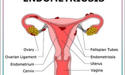 Empowering Awareness: Shedding Light on Endometriosis and Women's Well-being