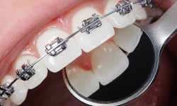A Confident Smile Starts Here: The Transformative Benefits of Dental Braces