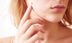 Expert Mole Removal in Dubai: Your Solution