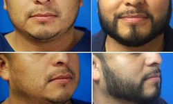 Enhance Your Look with Facial Hair Transplant Surgery