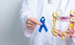 Detecting Colorectal Cancer Early: Symptoms, Diagnosis, and Treatment