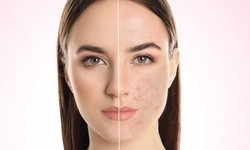 Your Guide to Acne Treatment Clinics in Islamabad
