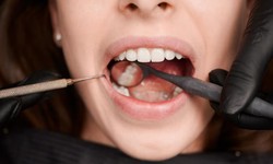 Your Smile: Exploring Gum Reshaping and Composite Fillings for Front Teeth