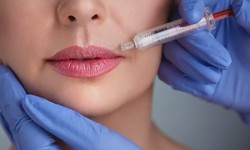 Experience the Glamour: Lip Fillers in Dubai Unleashed