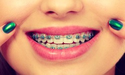Your FAQs on Braces Treatment Answered!