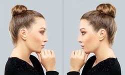 Nose Job Turkey Price: Budgeting for Your Transformation