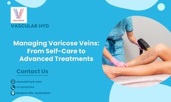 Managing Varicose Veins: From Self-Care to Advanced Treatments