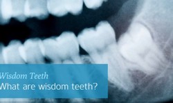 What should I learn about wisdom teeth extraction in Calgary?