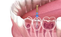 Root Canal Treatment Penrith