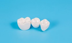 Unveiling the Power of Dental Crowns: A Complete Guide
