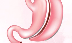Choosing the Best Gastric Sleeve Surgeon: Key Factors to Consider