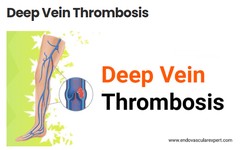 Chronic Venous Insufficiency: Effects of DVT on Vein Health