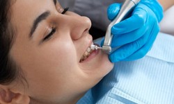 Same Day Crowns Near Me: What to Expect and How to Prepare