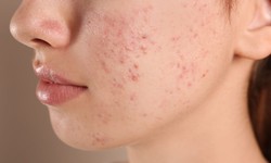 Is vitamin C good for acne scars?